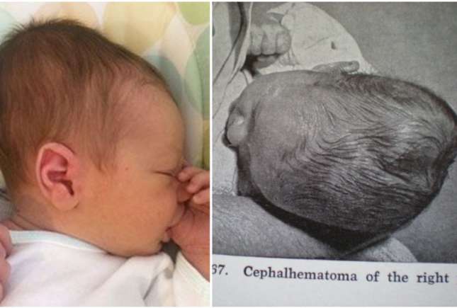 Medic neurolog-pediatru: Cefalhematomul la nou-născut poate apărea în cazul nașterilor dificile