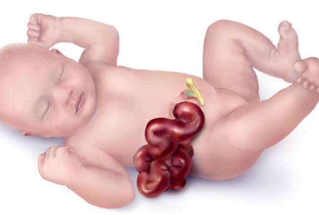 Gastroschizis la nou-născuți - una dintre cele mai frecvente malformații congenitale
