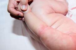 Iritația din cauza căldurii, la bebeluși. Cauze, prevenție și tratament