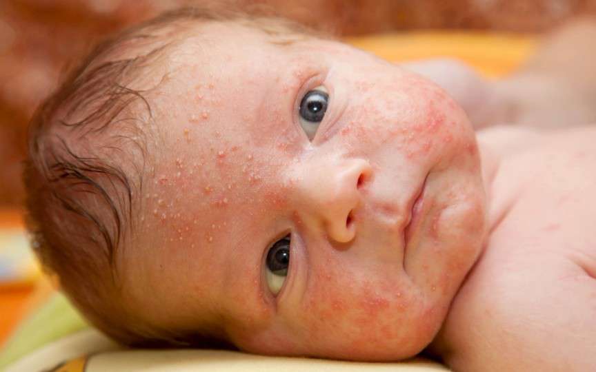 Cele mai întâlnite afecțiuni ale pielii la bebeluși – prevenție și tratament