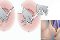 Tăierea peretelui vaginal la nașterea naturală – când este necesară?