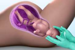 Cum previi ruperea vaginală în timpul nașterii