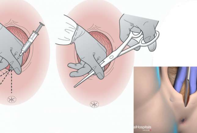 Tăierea peretelui vaginal la nașterea naturală – când este necesară?
