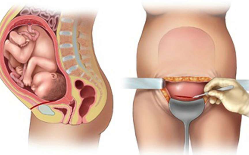 8 lucruri pe care trebuie să le știi dacă urmează să naști prin cezariană