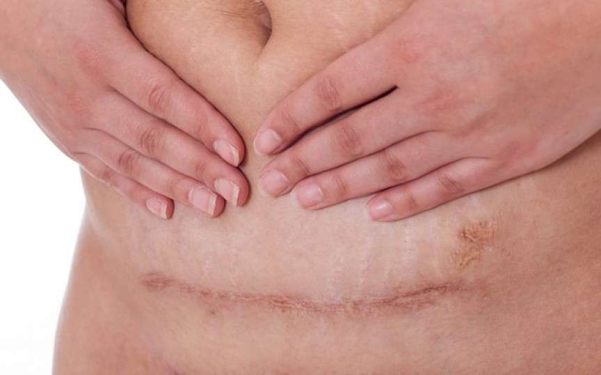 Ghidul complet de îngrijire după cezariană: cum contribui la o vindecare mai rapidă a cicatricei