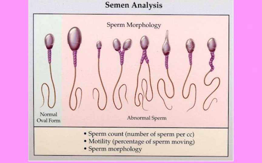 Specialist urologie-andrologie despre cele mai des întâlnite cauze ale infertilităţii la bărbaţi