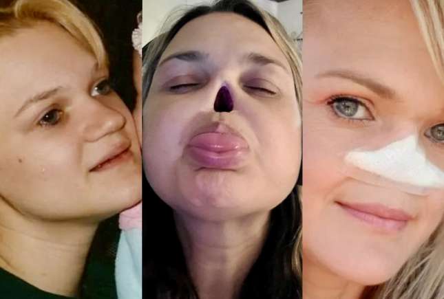 În loc de nas are o gaură și este mai fericită ca niciodată. Mama explică ce s-a întâmplat