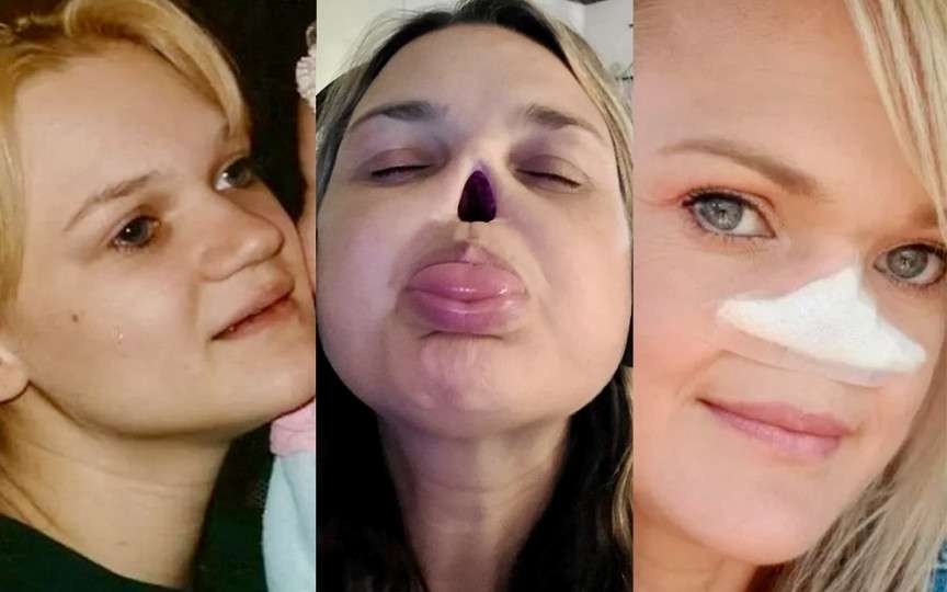 În loc de nas are o gaură și este mai fericită ca niciodată. Mama explică ce s-a întâmplat
