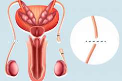 Medic obstetrician-ginecolog despre vasectomie: Această metodă de sterilizare definitivă a bărbatului nu afectează nivelul de testosteron