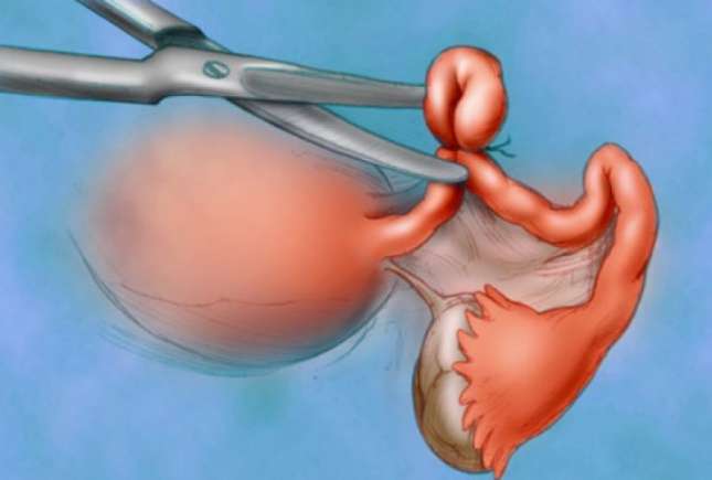 (VIDEO) Legarea trompelor uterine: cum se realizează și ce avantaje și dezavantaje are