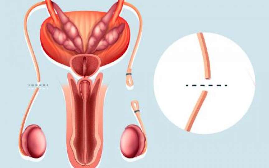 Medic obstetrician-ginecolog despre vasectomie: Această metodă de sterilizare definitivă a bărbatului nu afectează nivelul de testosteron