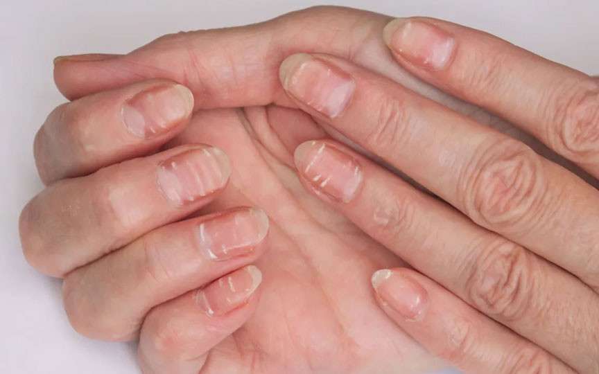 Ce înseamnă liniile și petele albe pe unghii – cauze, riscuri și când trebuie mers la medic