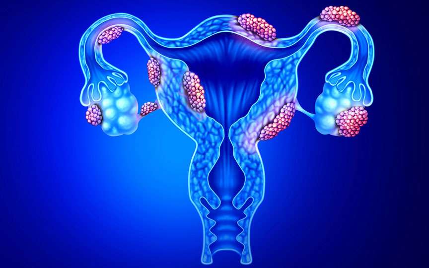 Spune-le fiicelor tale: 5 mituri despre endometrioză pe care trebuie să le știi