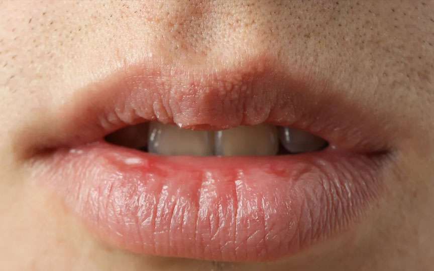 Xerostomia (uscăciunea gurii): cauze, simptome și tratament