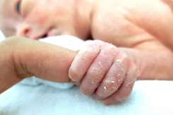 De ce se decojește pielea copiilor pe degete și când trebuie mers la medic