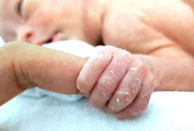 De ce se decojește pielea copiilor pe degete și când trebuie mers la medic