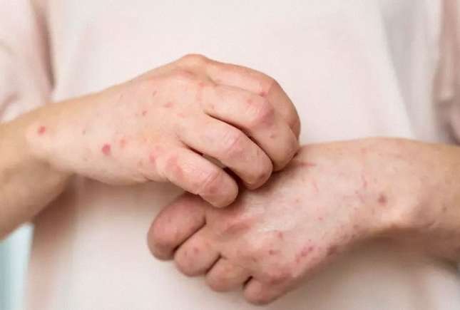 Rubeola la copii: simptome, tratament și prevenție