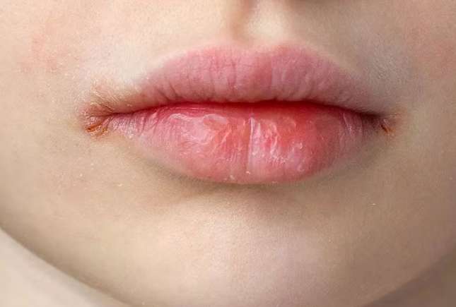 Cheilită angulară la copii: cauze, simptome, tratament și prevenție
