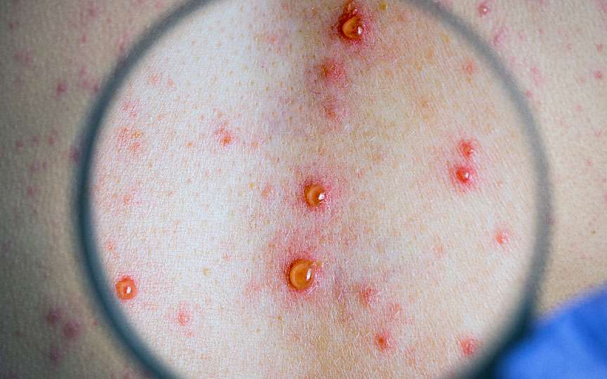 Varicela la copii: simptome, tratament și prevenție corectă
