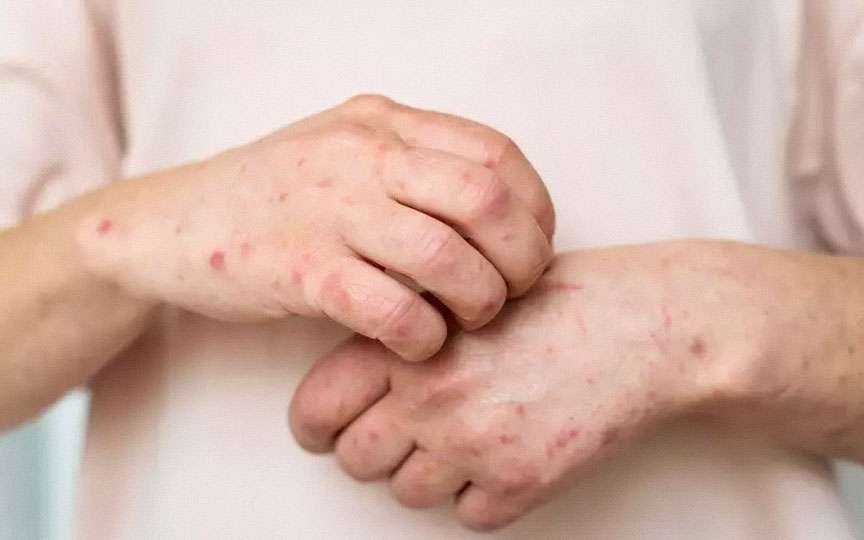 Rubeola la copii: simptome, tratament și prevenție