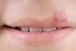 Herpes pe buze: cauze, tratament și prevenție