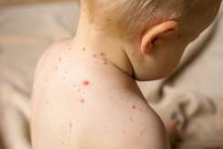 Rujeola în Moldova: aproape 200 de cazuri în 2025. ANSP avertizează că vaccinarea este esențială