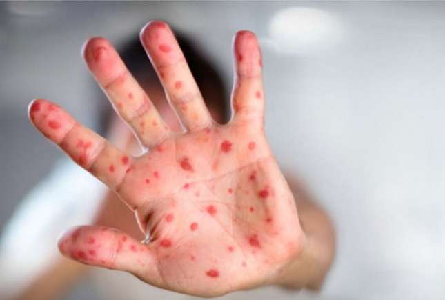 10 mituri periculoase despre rujeolă explicate de medici