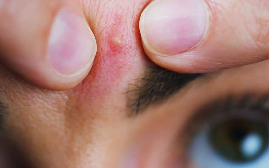 Acneea: cauze reale, mecanismul apariției și cum previi cicatricile