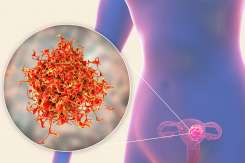 Adenocarcinomul uterin – cauze, simptome, diagnostic și tratament