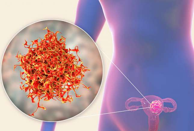 Adenocarcinomul uterin – cauze, simptome, diagnostic și tratament
