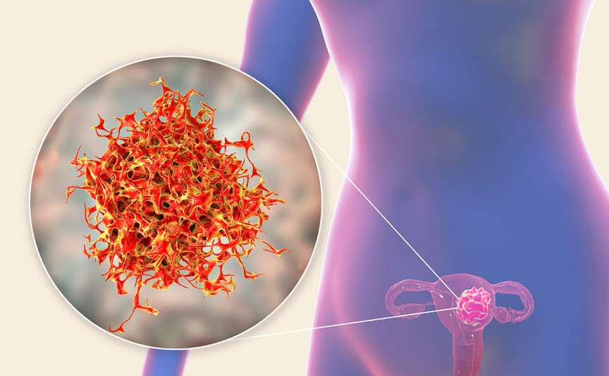 Adenocarcinomul uterin – cauze, simptome, diagnostic și tratament