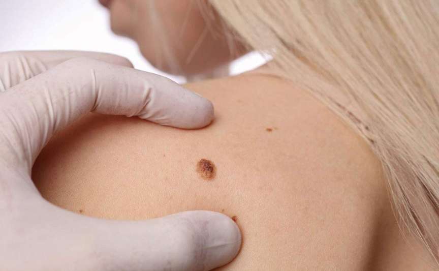 Cancerul de piele în Republica Moldova – date oficiale și recomandări pentru prevenție
