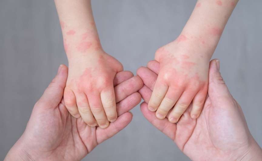 Urticaria la copii: cauze, simptome, tratament și semne care necesită ajutor urgent