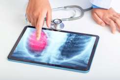 Screening pulmonar gratuit în raionul Ialoveni: program și localități disponibile între 29 iunie și 3 iulie