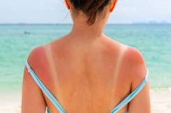 Arsurile solare repetate pot dubla riscul de cancer de piele, avertizează specialiștii
