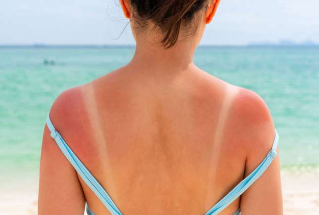 Arsurile solare repetate pot dubla riscul de cancer de piele, avertizează specialiștii