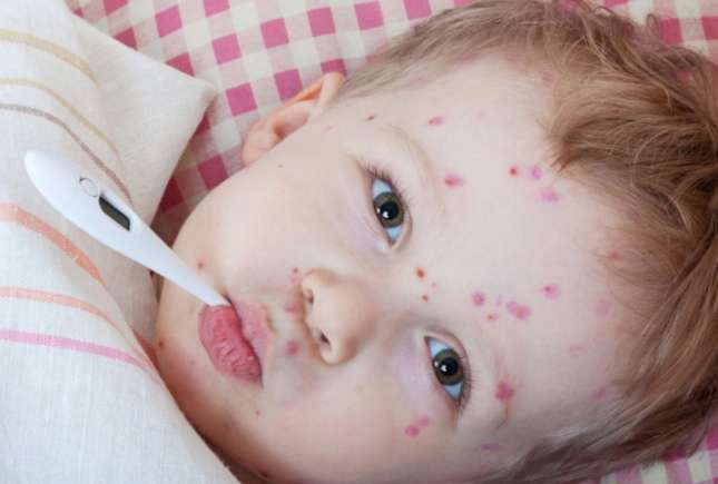 Copilul cu varicelă poate fi scăldat? Ce recomandă medicii pediatri