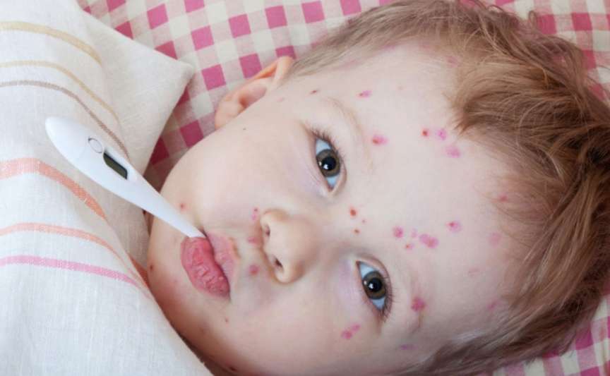 Copilul cu varicelă poate fi scăldat? Ce recomandă medicii pediatri